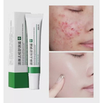 Creme Pomada Para Tirar Acne, Manchas Espinhas Hidratante